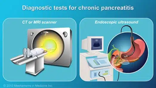 Chụp CT hoặc MRI vùng bụng và siêu âm nội soi trong chẩn đoán bệnh viêm tụy mạn tính. (Ảnh minh họa sưu tầm)