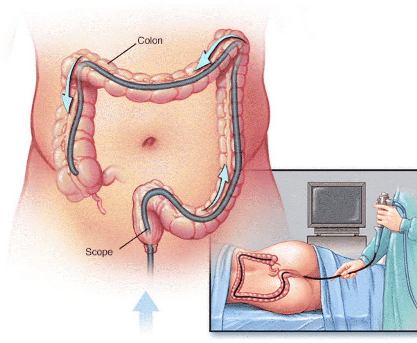 Nội soi tiêu hóa là phương pháp chính xác nhất trong chẩn đoán bệnh Crohn. (Ảnh minh họa sưu tầm)