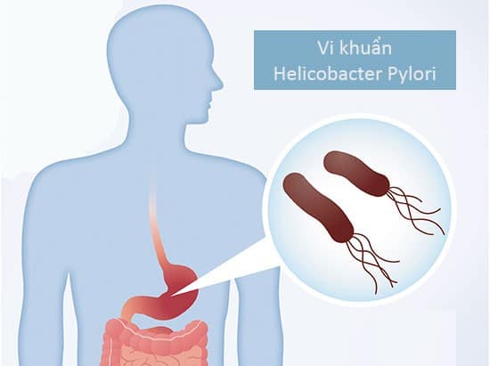 Nguyên nhân viêm trợt dạ dày phổ biến là do nhiễm vi khuẩn Helicobacter pylori. 