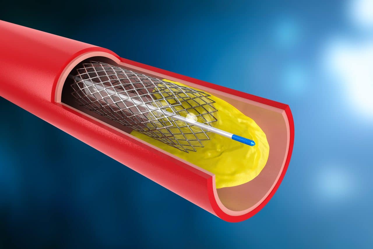 Phương pháp đặt stent tạo đường thông cửa chủ trong gan qua tĩnh mạch cảnh được chỉ định trong trường hợp điều trị xuất huyết tiêu hóa do vỡ giản tĩnh mạch thực quản.