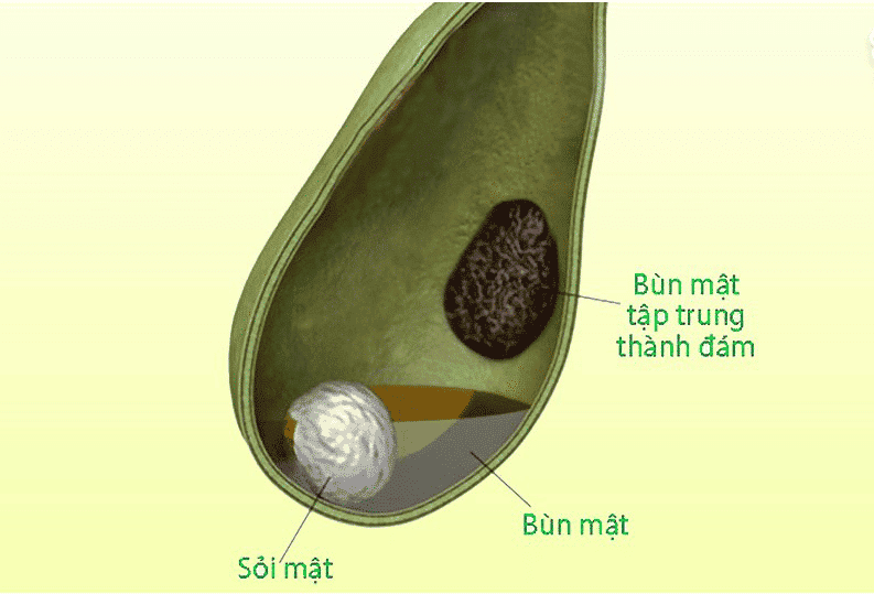 Sự kết hợp các tinh thể trong bùn mật và chất nhầy của màng túi mật trong thời gian kéo dài chính là điều kiện thuận lợi để tạo sỏi cholesterol trong túi mật. (Ảnh minh họa sưu tầm)