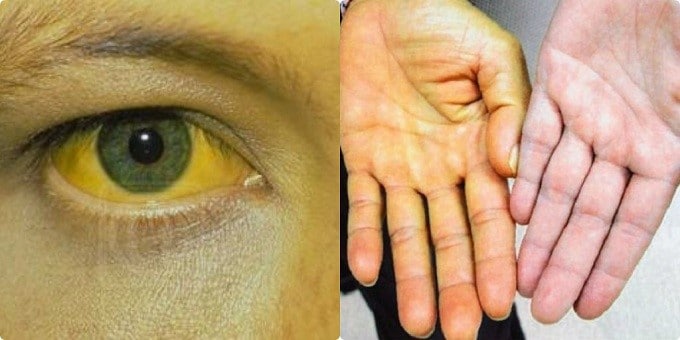 Biến chứng thường gặp ở người bệnh ung thư tụy là vàng da, mắt. (Ảnh minh họa sưu tầm)