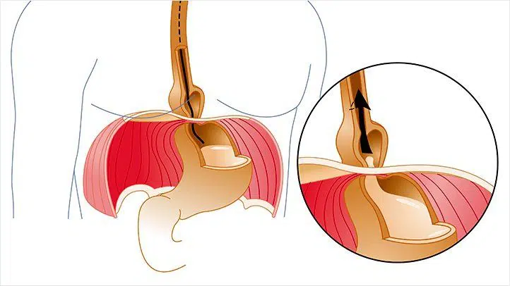 ợ trớ là triệu chứng phổ biến của bệnh trào ngược dạ dày – thực quản