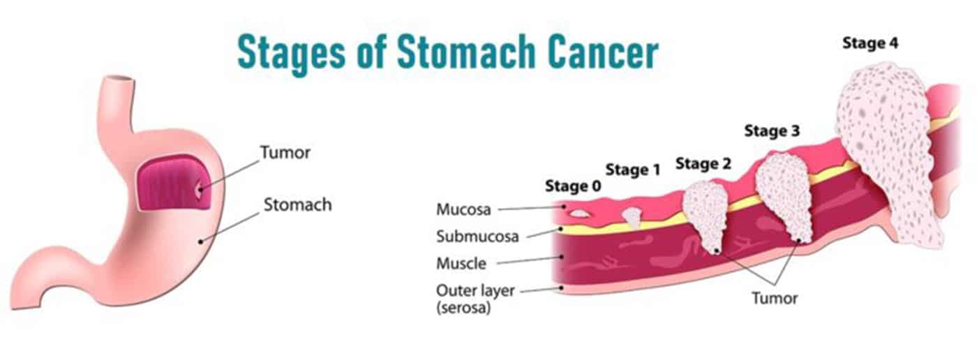 bệnh ung thư dạ dày giai đoạn 2
