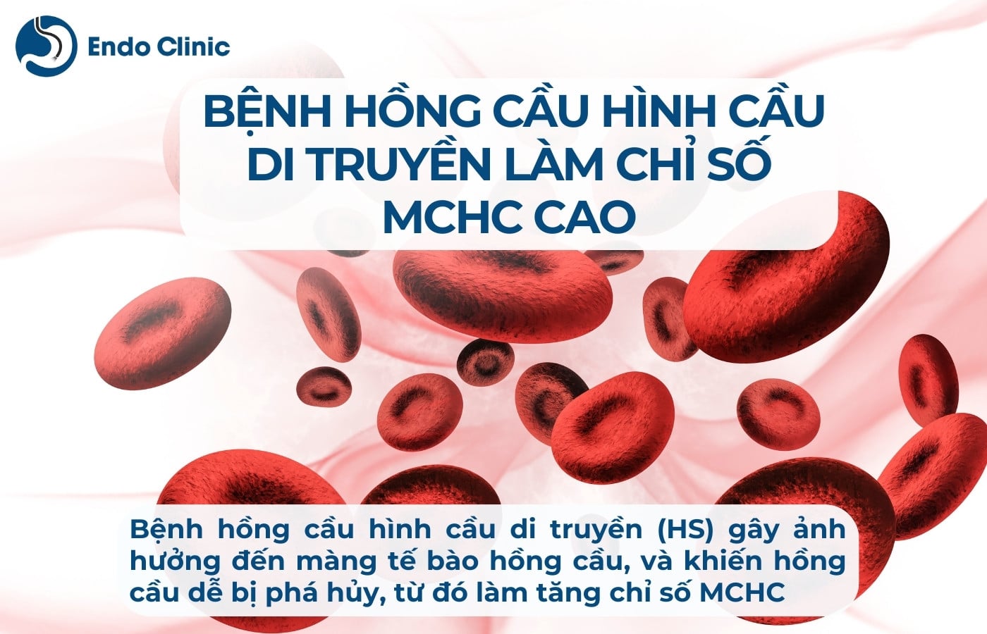 Bệnh hồng cầu hình cầu di truyền làm chỉ số MCHC trong xét nghiệm máu tăng cao