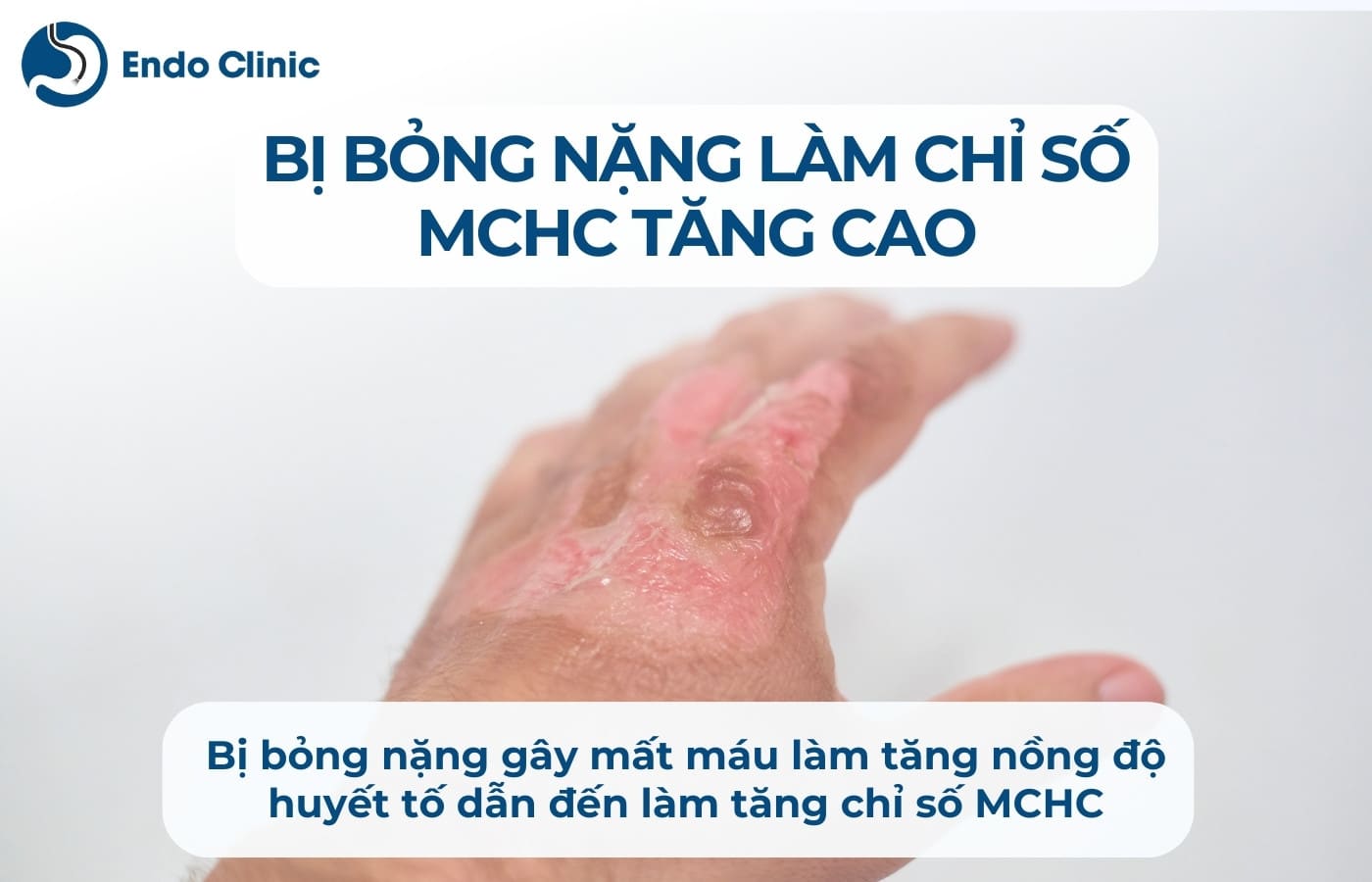 Bị bỏng nặng làm chỉ số MCHC trong xét nghiệm máu tăng cao