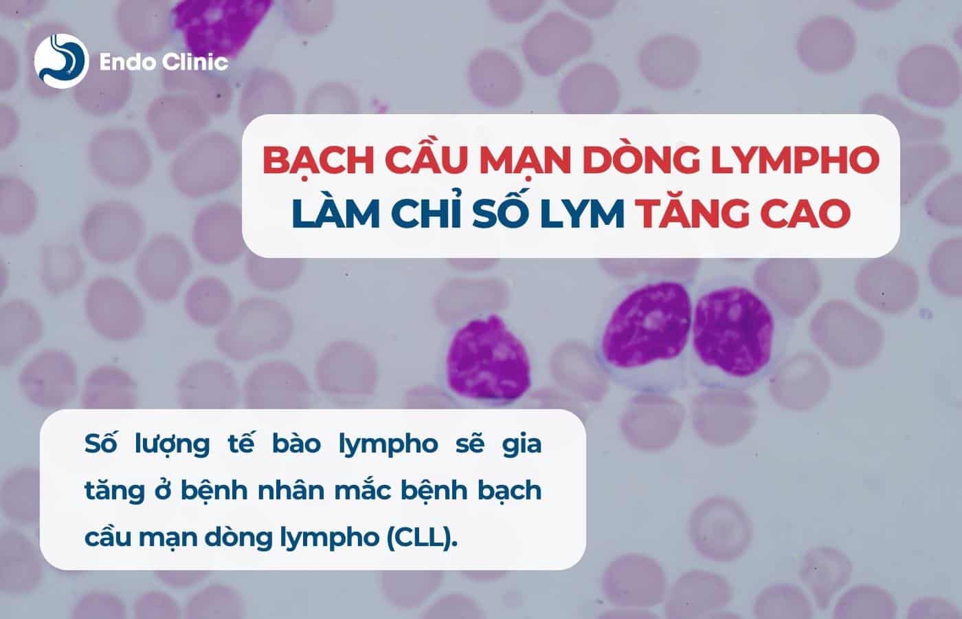 Bệnh bạch cầu mạn dòng lympho (CLL)