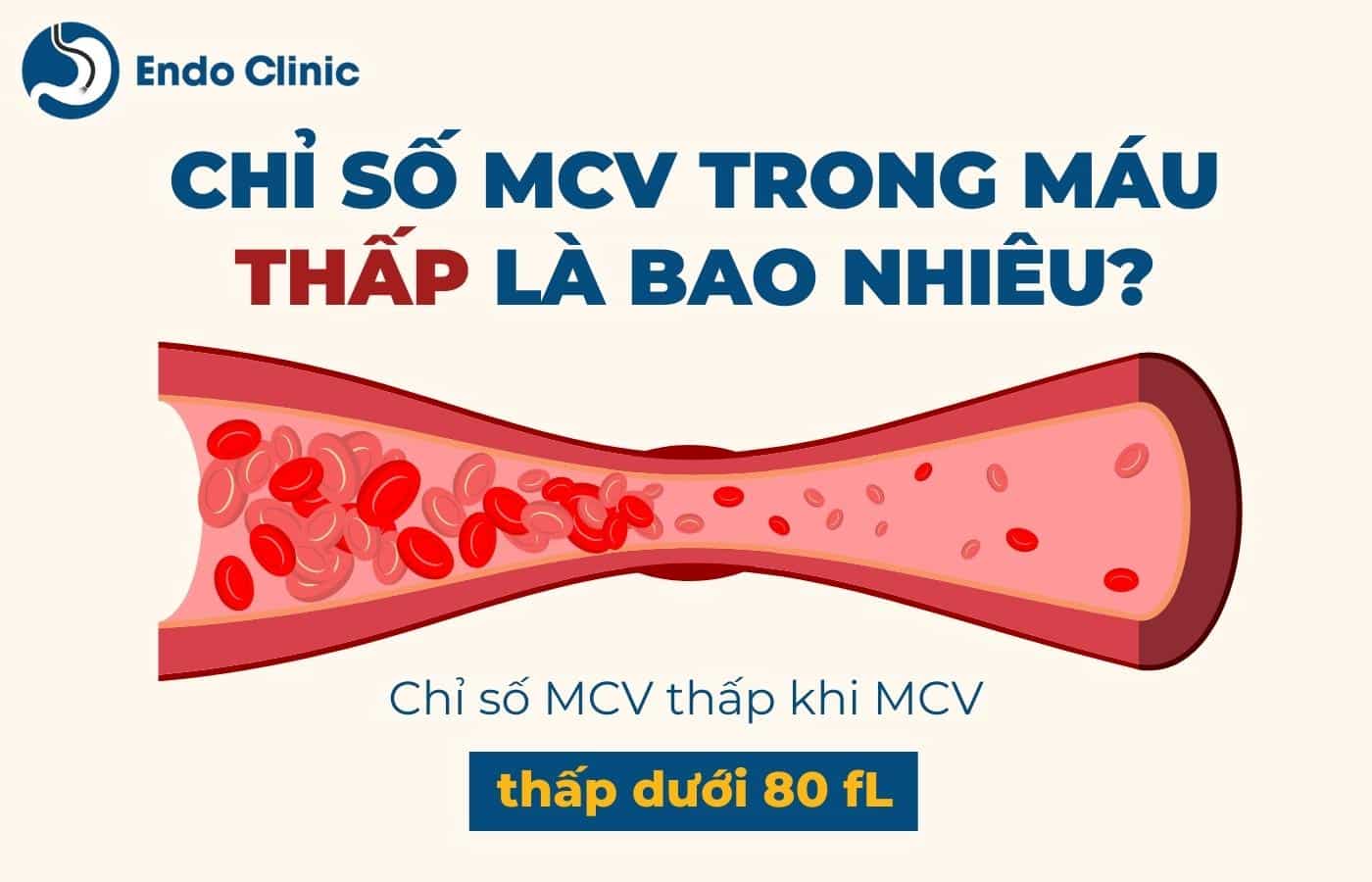 Chỉ số MCV trong xét nghiệm công thức máu thấp là bao nhiêu?